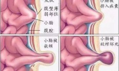 关爱老年疝气患者：春节期间的隐形风险