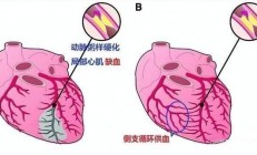 心梗患者为什么要吃糖(心梗患者为什么不能吃盐)